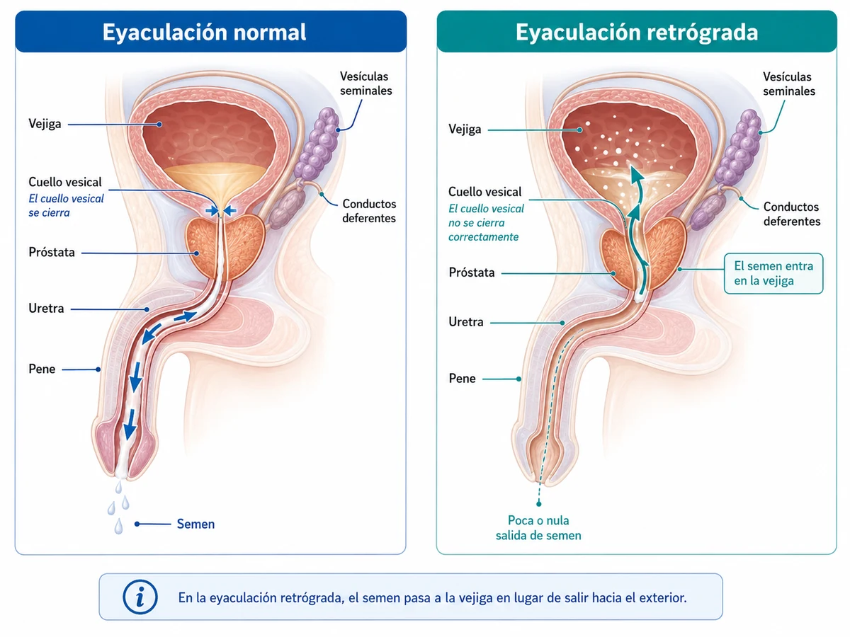 Comparación entre eyaculación normal y eyaculación retrógrada: en la normal el cuello vesical se cierra y el semen sale por la uretra; en la retrógrada el cuello vesical no se cierra y el semen pasa a la vejiga