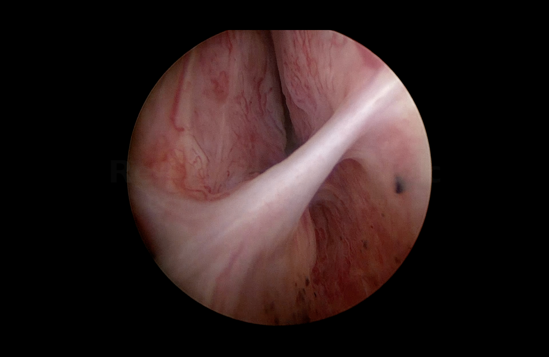 Uretra prostática obstruida antes de la enucleación