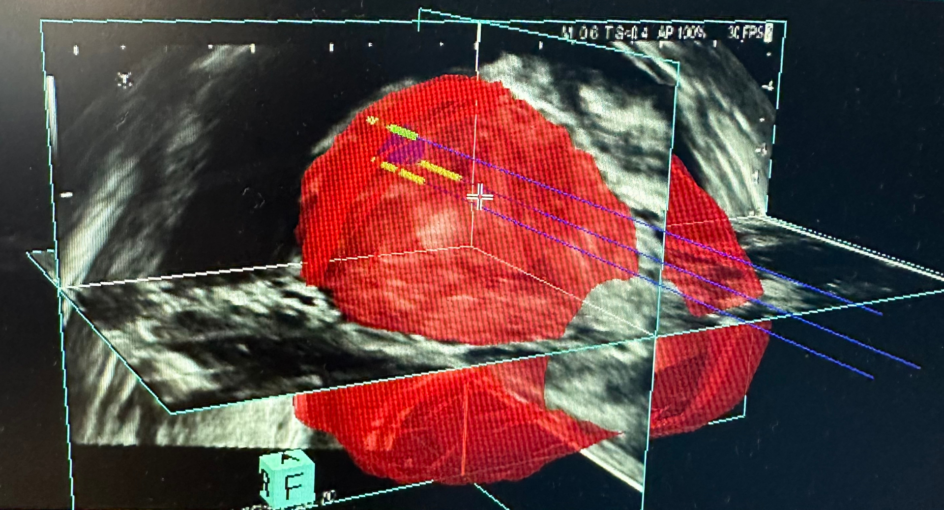Terapia Focal con IRE
